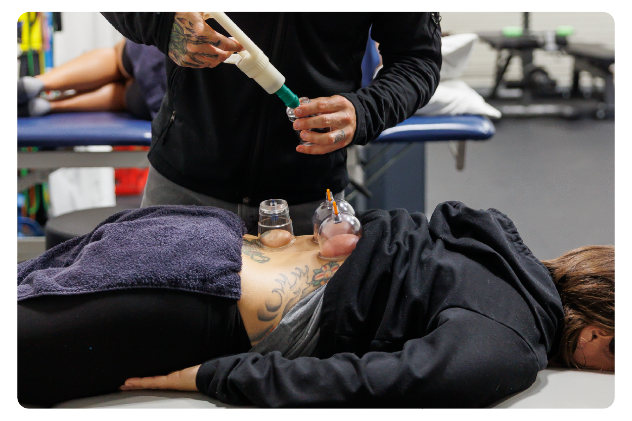 San Diego Cupping Therapy